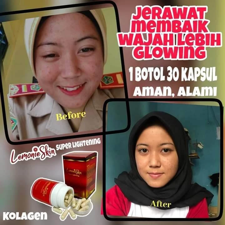 Cara Kolagen Atasi Rambut Rontok dengan Efektif dan Alami