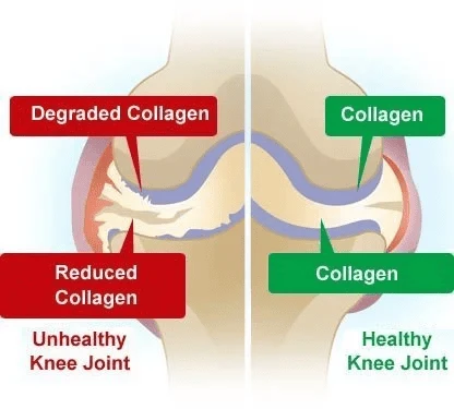 kolagen-dalam-manajemen-nyeri-sendi-studi-kasus-da - Apakah Kolagen Efektif untuk Mengurangi Nyeri Sendi dan Osteoarthritis?
