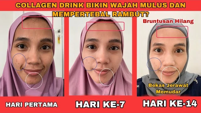rekomendasi-produk-kolagen-terbaik-untuk-kulit-rem - Review Produk Kolagen Terbaik untuk Kulit Remaja Aman dan Efektif